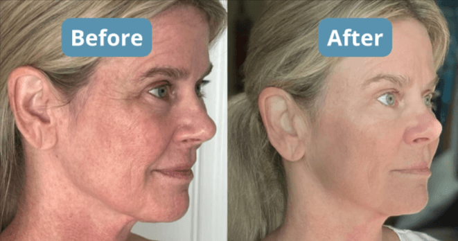 Total Night Cream Before and After